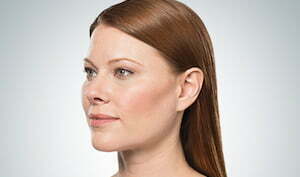 kybella