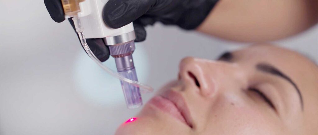 Advanced Microneedling Procedures