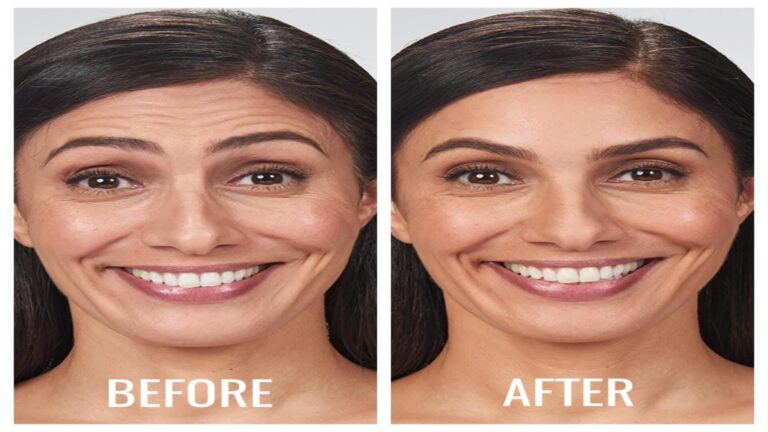 Botox Boston Fullface