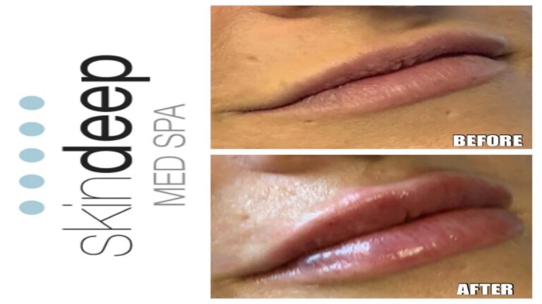 Lip filler with correction