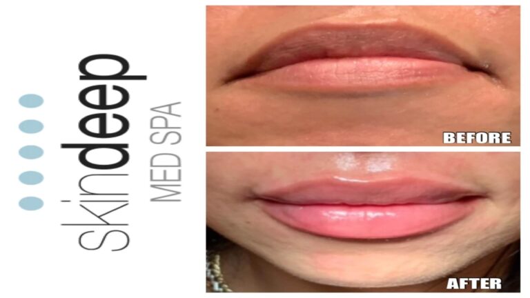 Lip filler with downturn to upturn correction