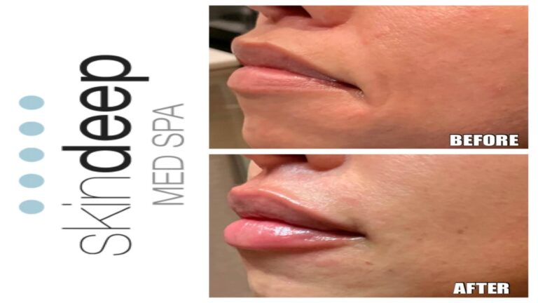 Lip filler with downturn to upturn correction_1